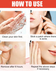 144 Hydrocolloid Acne Patches Round Stickers for Zits Blemish Care
